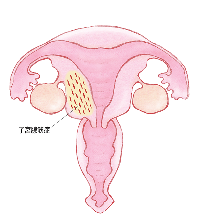 子宮腺筋症のイメージ
